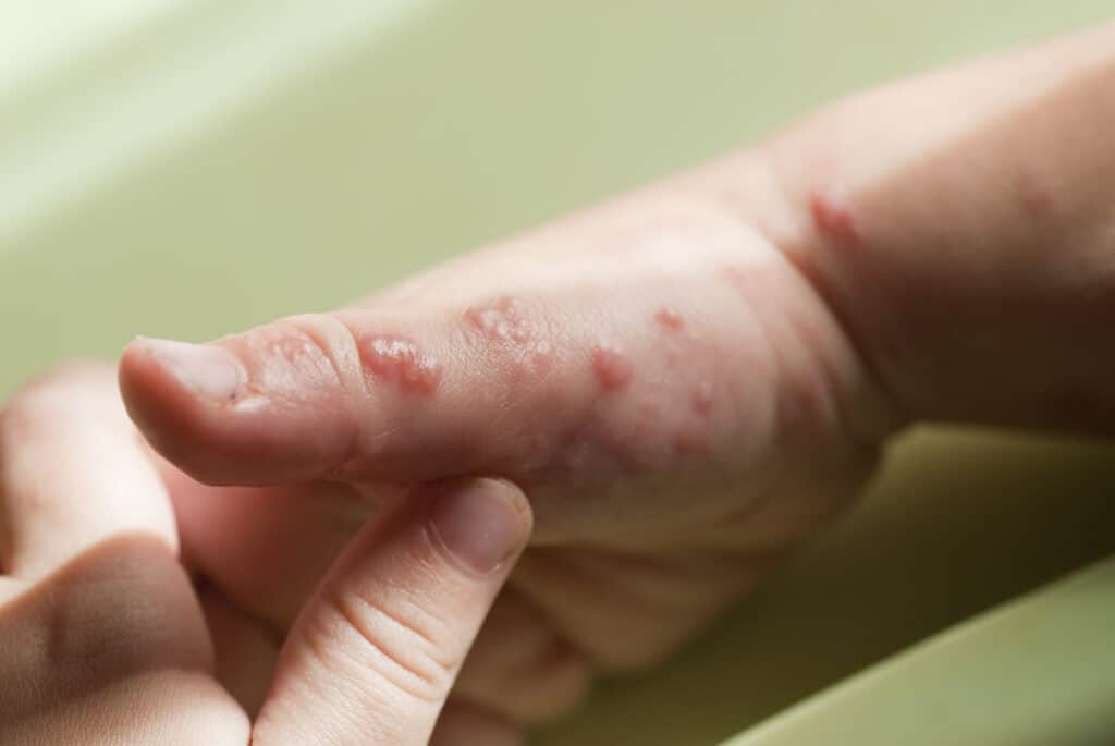 Got rashes? How do you know it's Monkeypox, not something else?